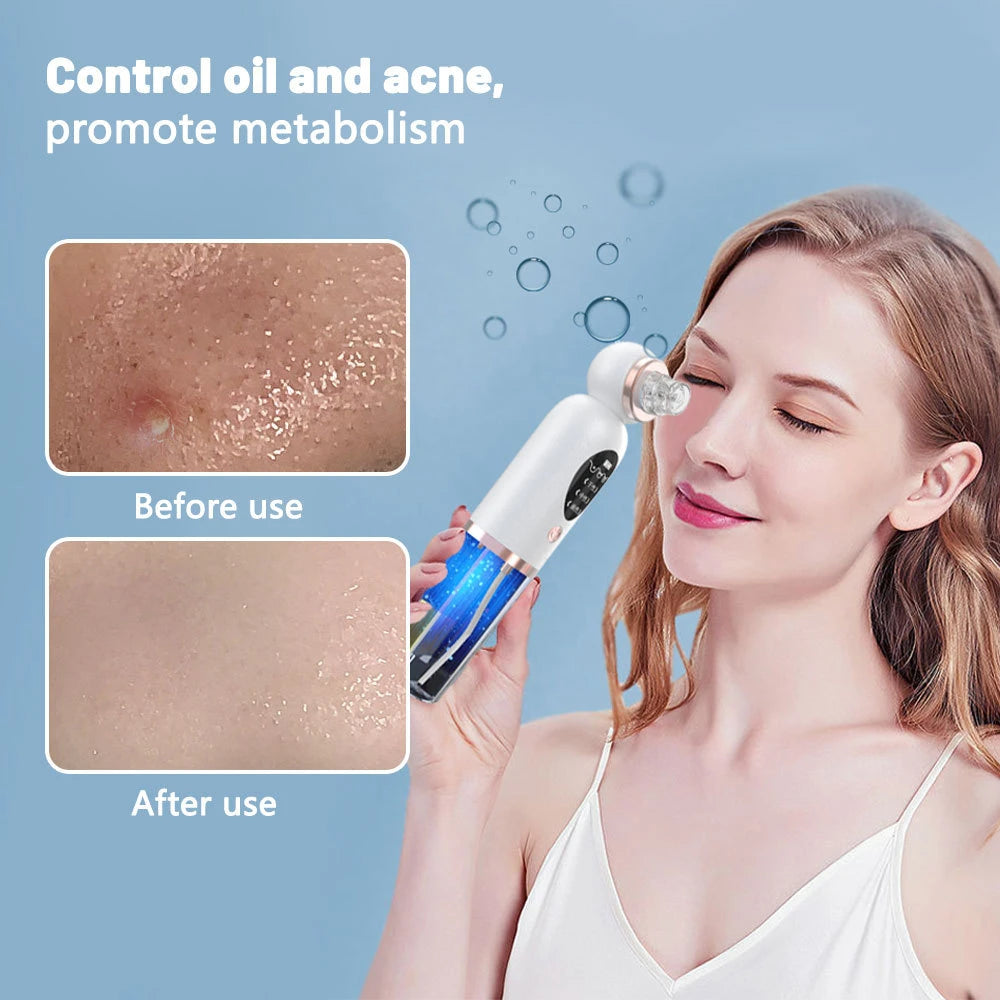 Ultra Fine Small Bubble Vacuum Black Head Blackhead Acne Remover Suction Vacuum Facial Kit Pore Cleaner Machine for Women (Blackhead Remover)