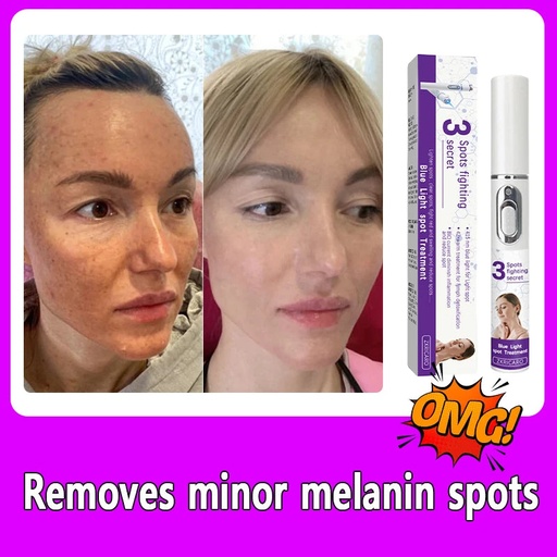 [6069db94-63d2-40fa-a9e3-a513fdc93030] Facial Spots Disappear, Making You 18 Years Younger (Pack Of 1Pcs)